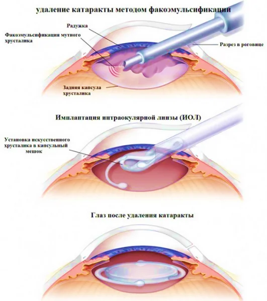 Этапы ультразвуковой факоэмульсификации