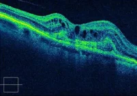 Оптическая когерентная томография влажной формы ВМД и макулярного отека.