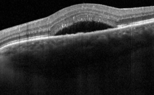 Оптическая когерентная томография влажной формы ВМД и макулярного отека.